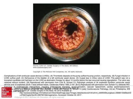 Complications of left ventricular assist devices (LVADs)