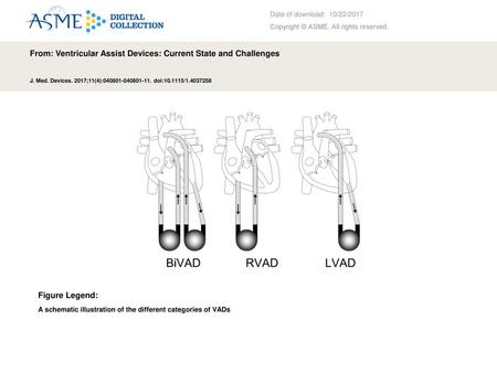 From: Ventricular Assist Devices: Current State and Challenges