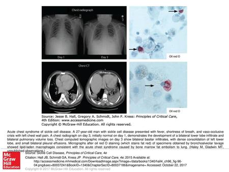 Acute chest syndrome of sickle cell disease