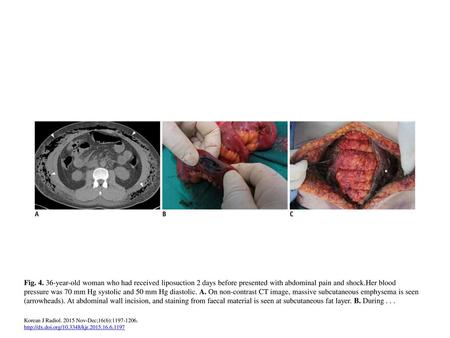 Fig. 4. 36-year-old woman who had received liposuction 2 days before presented with abdominal pain and shock.Her blood pressure was 70 mm Hg systolic and.