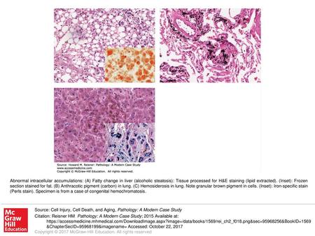 Abnormal intracellular accumulations: (A) Fatty change in liver (alcoholic steatosis): Tissue processed for H&E staining (lipid extracted). (Inset): Frozen.