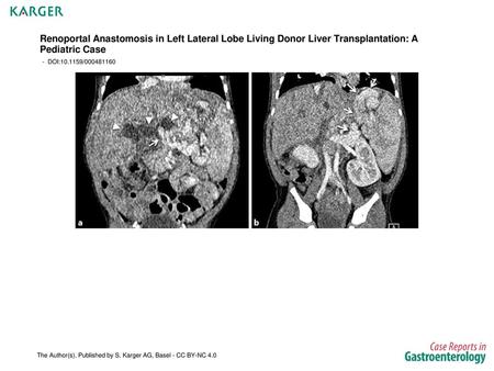 Renoportal Anastomosis in Left Lateral Lobe Living Donor Liver Transplantation: A Pediatric Case - DOI:10.1159/000481160 Fig. 1. Pretransplant computed.