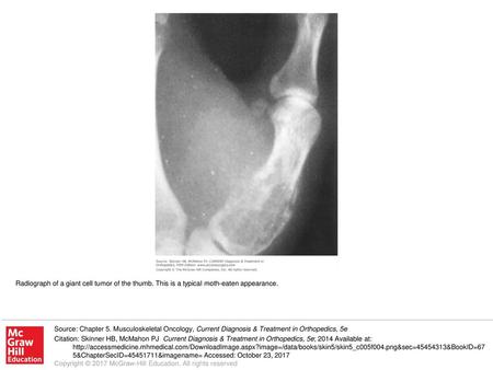 Radiograph of a giant cell tumor of the thumb