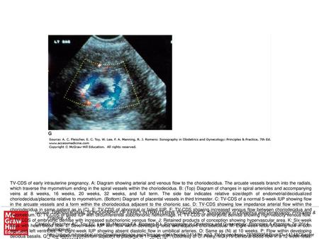 TV-CDS of early intrauterine pregnancy