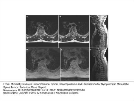 FIGURE 1. Axial T2 (A, B) and T1 postgadolinium (D, E) spinal magnetic resonance imaging demonstrating a contrast-enhancing mass at T4 and T5 with significant.