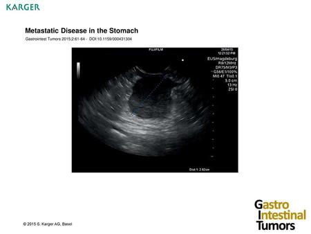 Metastatic Disease in the Stomach