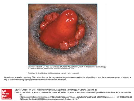 Granulomas around a colostomy