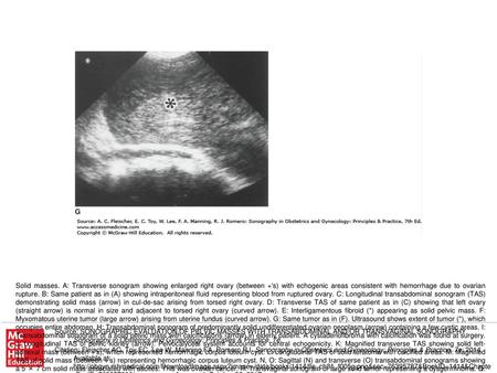 Solid masses. A: Transverse sonogram showing enlarged right ovary (between +'s) with echogenic areas consistent with hemorrhage due to ovarian rupture.