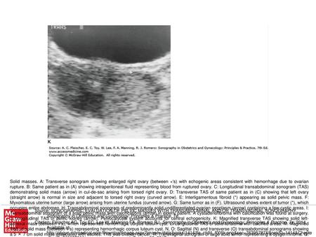 Solid masses. A: Transverse sonogram showing enlarged right ovary (between +'s) with echogenic areas consistent with hemorrhage due to ovarian rupture.