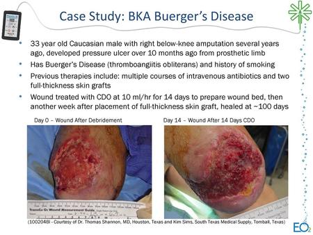 Case Study: BKA Buerger’s Disease