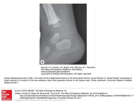 Classic Metaphyseal Lesion (CML)