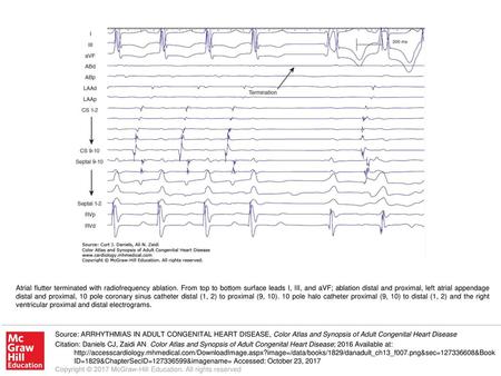 Atrial flutter terminated with radiofrequency ablation