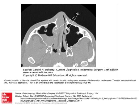 Chronic sinusitis. In this axial plane CT of a patient with chronic sinusitis, radiographic evidence of inflammation can be seen. The right nasolacrimal.