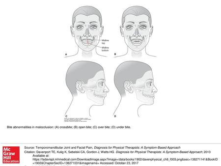 Bite abnormalities in malocclusion: (A) crossbite; (B) open bite; (C) over bite; (D) under bite. Source: Temporomandibular Joint and Facial Pain, Diagnosis.