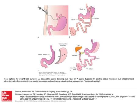 Four options for weight loss surgery: (A) adjustable gastric banding; (B) Roux-en-Y gastric bypass; (C) gastric sleeve resection; (D) biliopancreatic diversion.