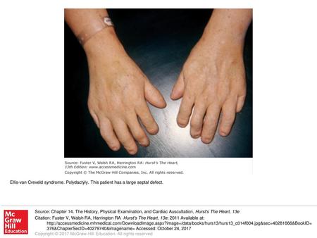 Ellis-van Creveld syndrome. Polydactyly