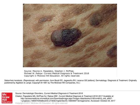 Seborrheic keratosis. (Reproduced, with permission, from Bondi EE, Jegasothy BV, Lazarus GS [editors]. Dermatology: Diagnosis & Treatment. Originally published.