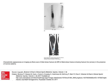 Characteristic appearances on imaging (a) Bone scan of tibial stress fracture (b) MRI of tibial stress fracture showing fracture line (arrows) in the presence.