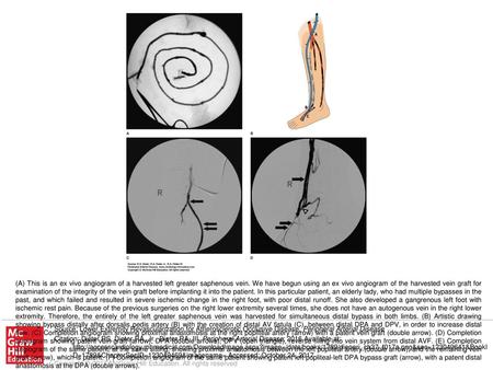 (A) This is an ex vivo angiogram of a harvested left greater saphenous vein. We have begun using an ex vivo angiogram of the harvested vein graft for examination.