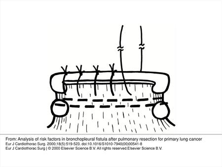 Fig. 1 Diagram of method C for bronchial closure