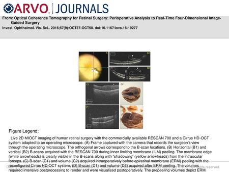 From: Optical Coherence Tomography for Retinal Surgery: Perioperative Analysis to Real-Time Four-Dimensional Image-Guided Surgery Invest. Ophthalmol. Vis.