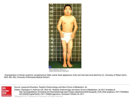 Characteristics of Scheie syndrome: broadened but milder coarse facial appearance (A,B) and mild claw-hand deformity (C). (Courtesy of Robert Gorlin, DDS,