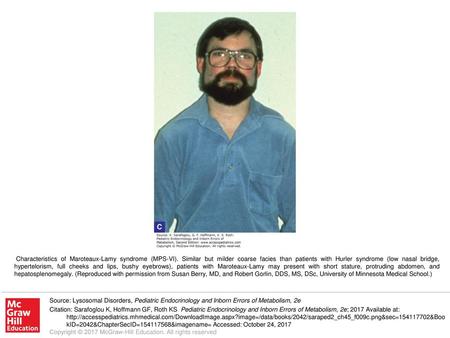 Characteristics of Maroteaux-Lamy syndrome (MPS-VI)