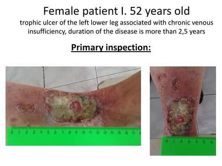 Female patient I. 52 years old trophic ulcer of the left lower leg associated with chronic venous insufficiency, duration of the disease is more than 2,5.