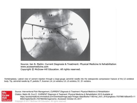 Vertebroplasty. Lateral view of cement injection through a large-gauge Jamshidi needle into the osteoporotic compression fracture of the L5 vertebral body.