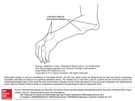 Rheumatoid nodules, a common complication of rheumatoid arthritis, not only may result in pain and disfigurement but also may lead to compressive neuropathy.