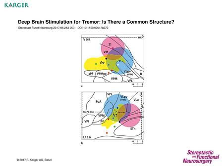 Deep Brain Stimulation for Tremor: Is There a Common Structure?