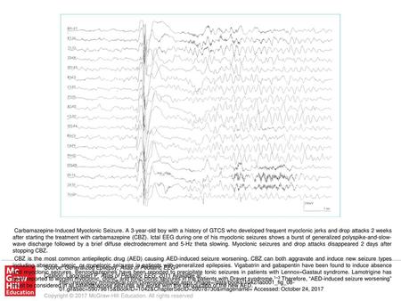 CBZ is the most common antiepileptic drug (AED) causing AED-induced seizure worsening. CBZ can both aggravate and induce new seizure types including absence,