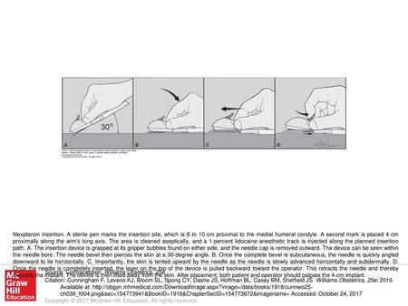 Nexplanon insertion. A sterile pen marks the insertion site, which is 8 to 10 cm proximal to the medial humeral condyle. A second mark is placed 4 cm proximally.