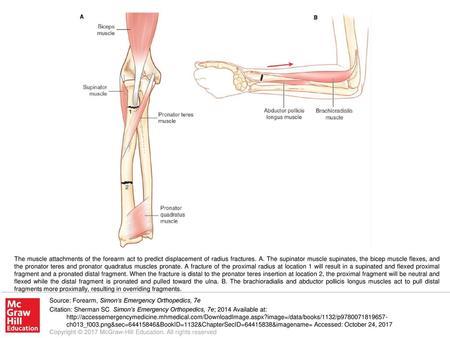 The muscle attachments of the forearm act to predict displacement of radius fractures. A. The supinator muscle supinates, the bicep muscle flexes, and.