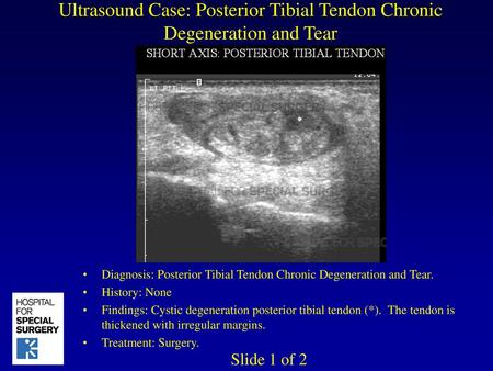 Ultrasound Case: Posterior Tibial Tendon Chronic Degeneration and Tear