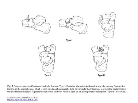 Fig. 2. Sangeorzan's classification of navicular fracture