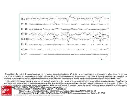 In this patient, the ground electrode was placed on the forehead and the low-impedance active electrode occurred in the occipital region. Therefore, the.