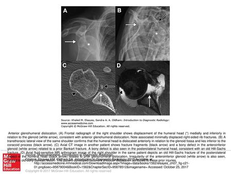 Anterior glenohumeral dislocation