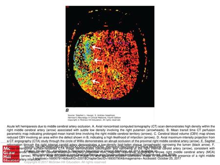 Acute left hemiparesis due to middle cerebral artery occlusion. A