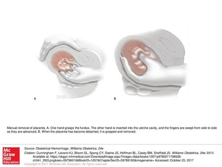 Manual removal of placenta. A. One hand grasps the fundus