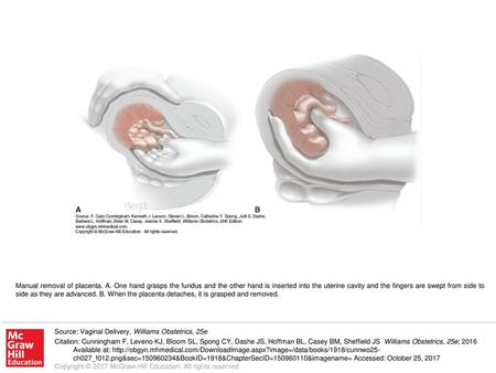 Manual removal of placenta. A