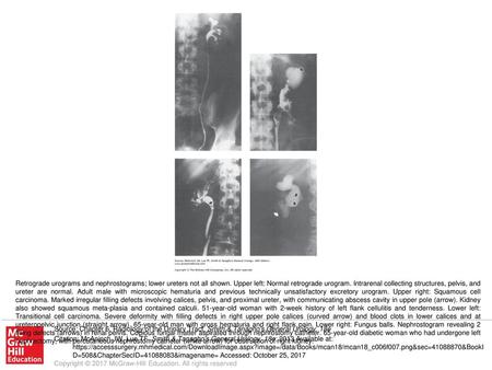 Retrograde urograms and nephrostograms; lower ureters not all shown