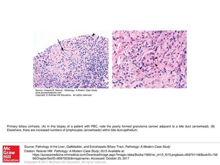 Primary biliary cirrhosis