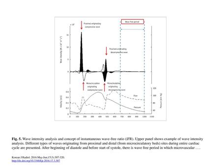 Fig. 5. Wave intensity analysis and concept of instantaneous wave-free ratio (iFR). Upper panel shows example of wave intensity analysis. Different types.