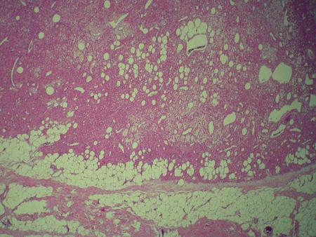 CD34: negative S-100: negative Actin: negative Desmin: negative Cytokeratin: Negative FGF-23: not-available DDX: -Hemangiopericytoma -Glomus.