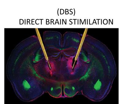 (DBS) DIRECT BRAIN STIMILATION