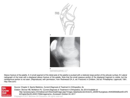 Sleeve fracture of the patella