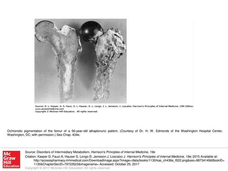 Ochronotic pigmentation of the femur of a 56-year-old alkaptonuric patient. (Courtesy of Dr. H. W. Edmonds of the Washington Hospital Center, Washington,