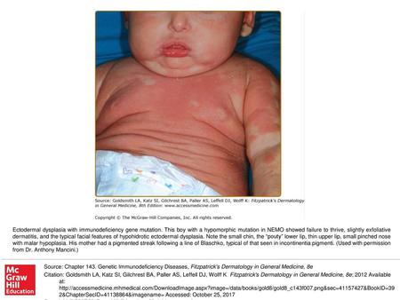 Ectodermal dysplasia with immunodeficiency gene mutation