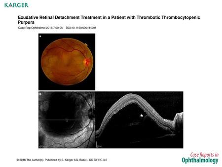 Case Rep Ophthalmol 2016;7: DOI: /